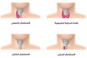 استئصال الغدة الدرقية مع دكتور احمد سفينة