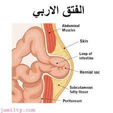 الفتق الإربي مع دكتور احمد سفينة