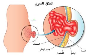 أنواع الفتق الإربي