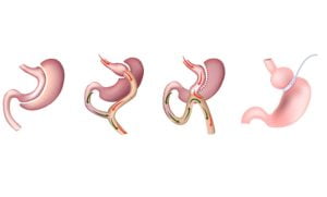 علامات تدل على احتياج إلى تصحيح عمليات السمنة