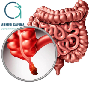  ما هي أعراض الزائدة الدودية مع دكتور احمد سفينة