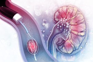 انسداد القناة الصفراوية