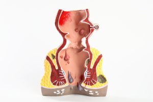 تدبيس البواسير
