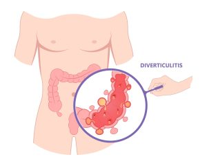 طرق تشخيص التهاب الزائدة الدودية بالمنظار
