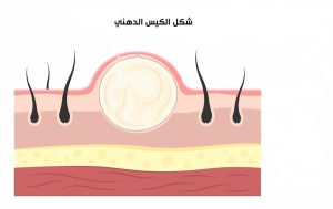 ما هي أسباب ظهور الكيس الدهني؟ وما شكل الكيس الدهني؟