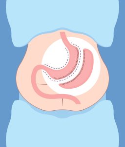 سعر عملية تكميم المعدة في القصر العيني