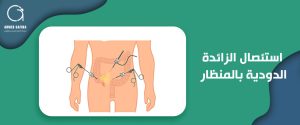 استئصال الزائدة الدودية بالمنظار