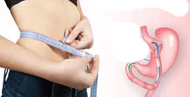 خطوات إجراء عملية تحويل مسار المعدة المصغر