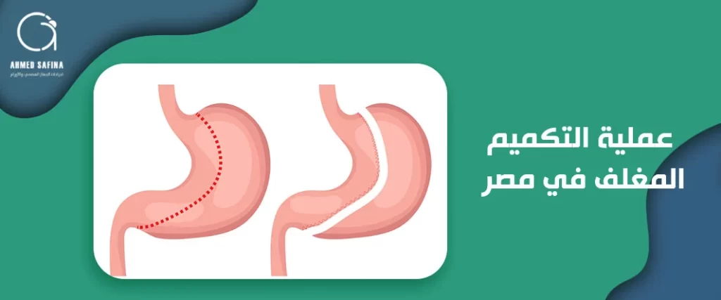 عملية التكميم المغلف في مصر