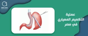 عملية التكميم المعياري في مصر