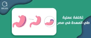 تكلفة عملية طي المعدة في مصر