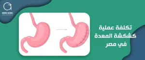 تكلفة عملية كشكشة المعدة في مصر