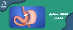 عملية التكميم المعدل 