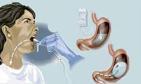 تركيب بالون المعدة