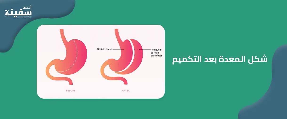 شكل المعدة بعد التكميم