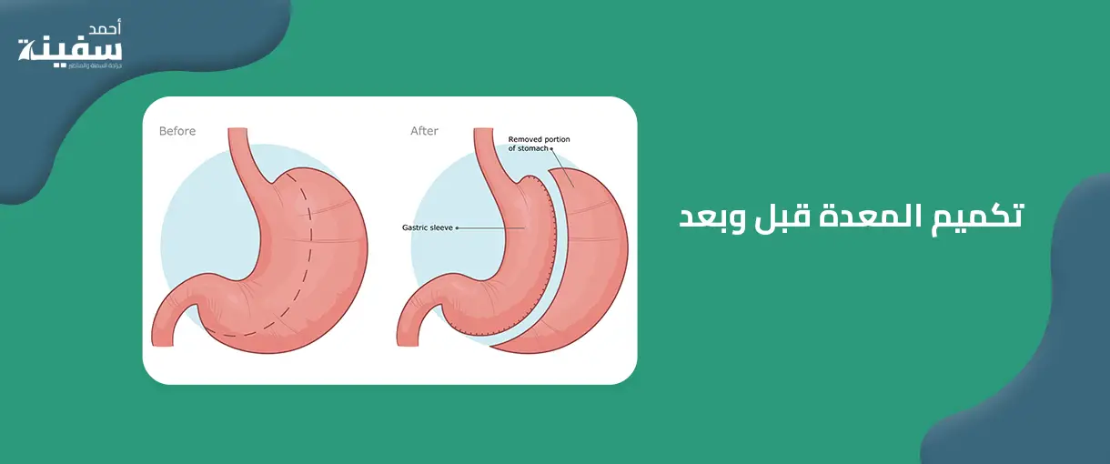 تكميم المعدة قبل وبعد