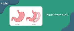عملية تكميم المعدة قبل وبعد