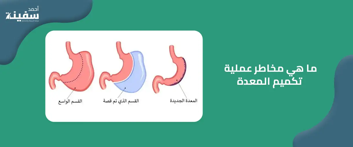 ما هي مخاطر عملية تكميم المعدة