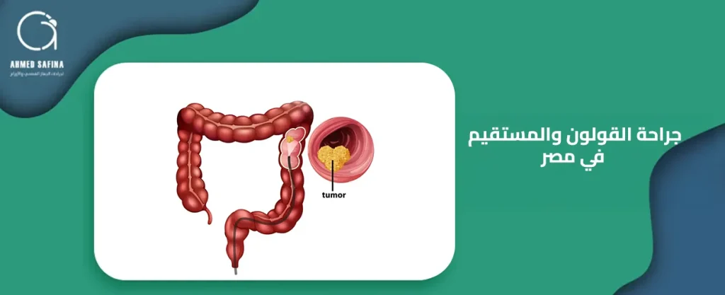 جراحة القولون والمستقيم في مصر