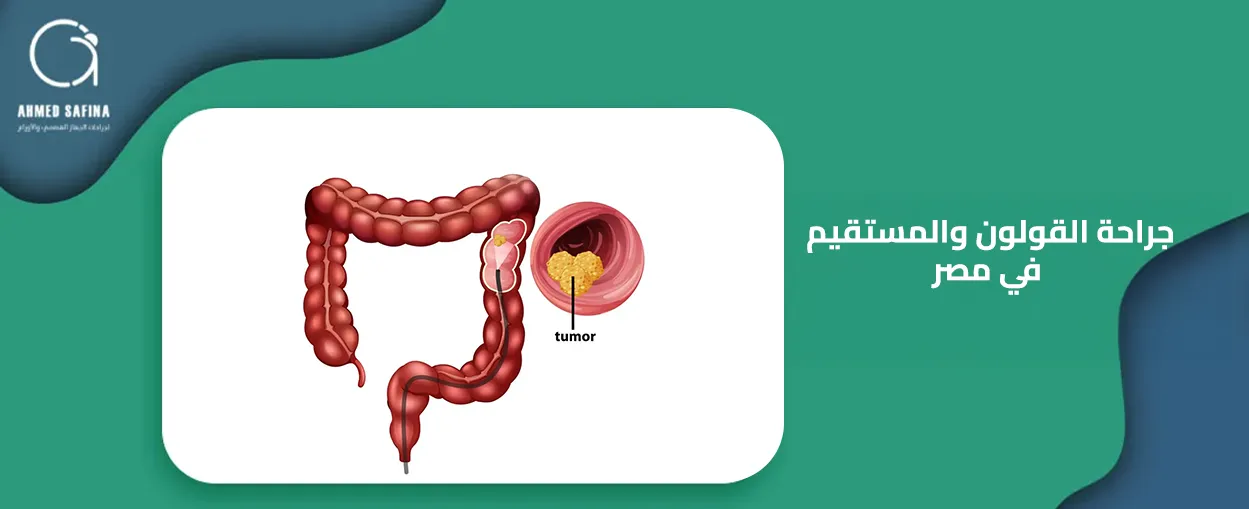 جراحة القولون والمستقيم في مصر