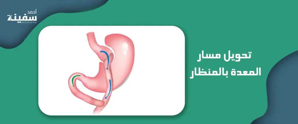 تحويل مسار المعدة بالمنظار