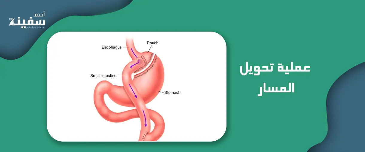 عملية تحويل المسار