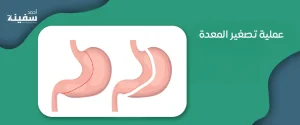 عملية تصغير المعدة