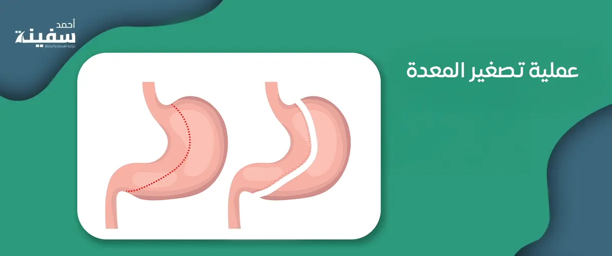 عملية تصغير المعدة