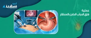 عملية فتق الحجاب الحاجز بالمنظار